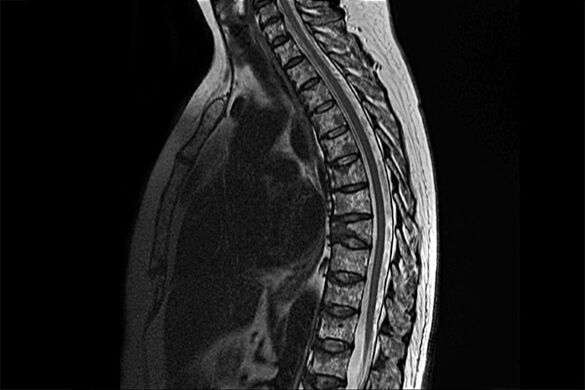 MRG görüntüsünde torasik osteokondroz belirtileri