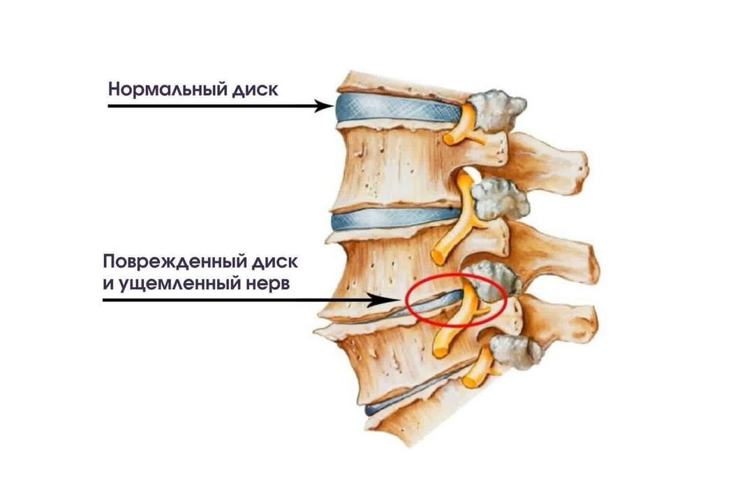 Servikal osteokondroz semptomları