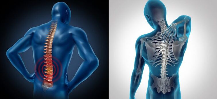Spinal osteokondrozda inflamasyon