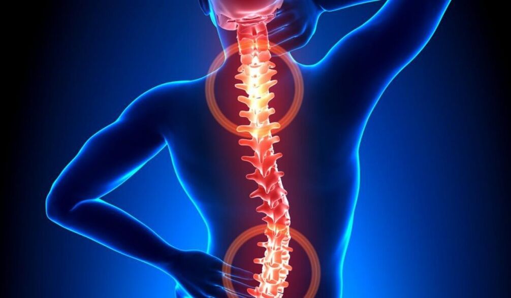 omurga osteokondrozu