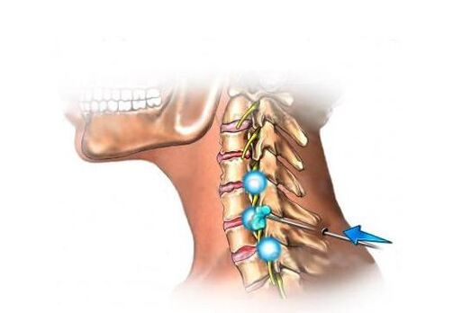 servikal osteokondroz tedavisi